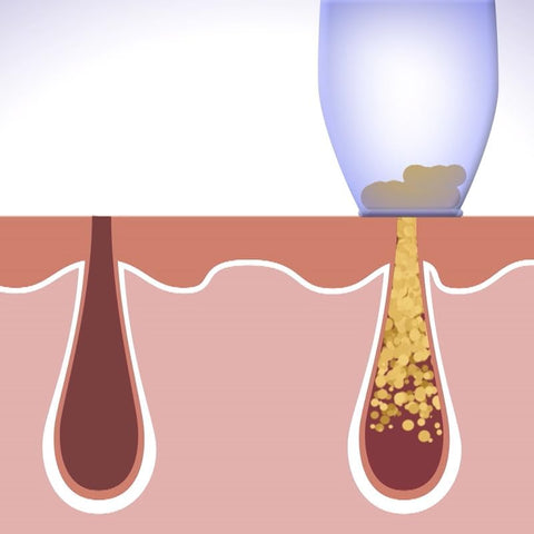 Derma Suction 3-in-1 Blackhead Remover Machine – Acne, Pimple & Pore Vacuum Cleaner Tool