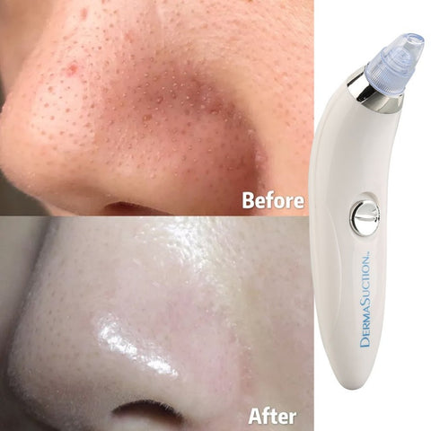 Derma Suction 3-in-1 Blackhead Remover Machine – Acne, Pimple & Pore Vacuum Cleaner Tool